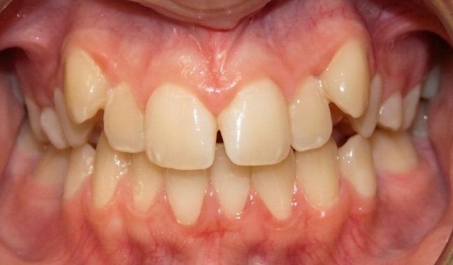 Vivid Smiles patient case 15 before and after treatment comparison before